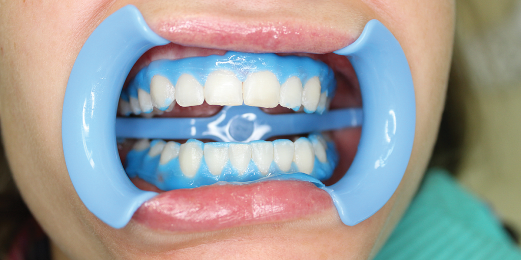 Что такое химическое отбеливание зубов. Эффективно, но не всегда безопасно