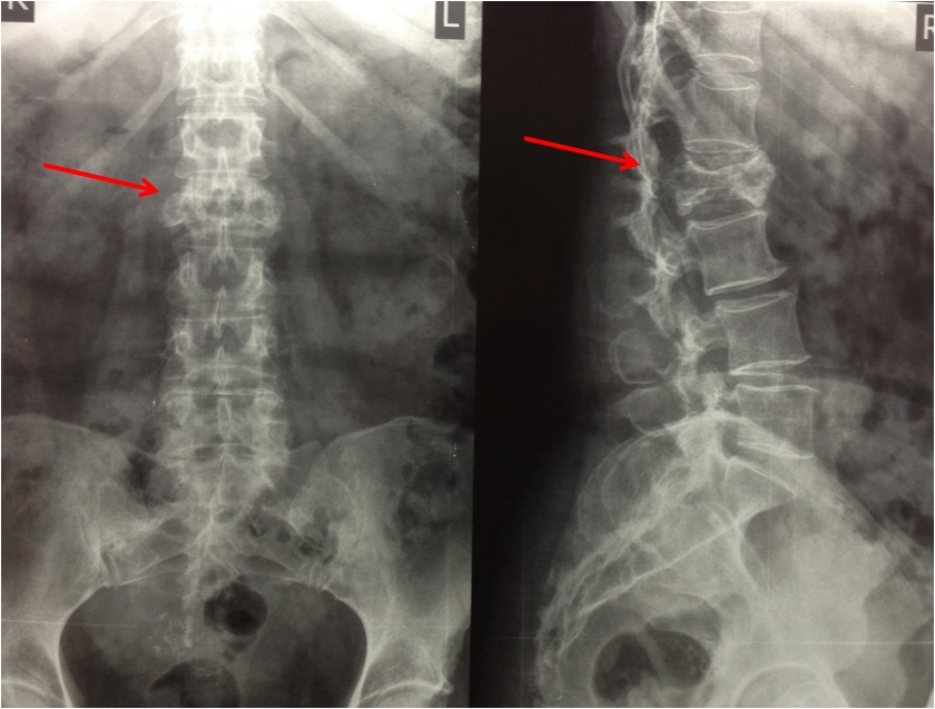 Метастатическое поражение костей. Метастазы в позвоночнике рентген. Метастазы в позвоночнике рентгенограмма. Остеосаркома позвоночника на рентгене.