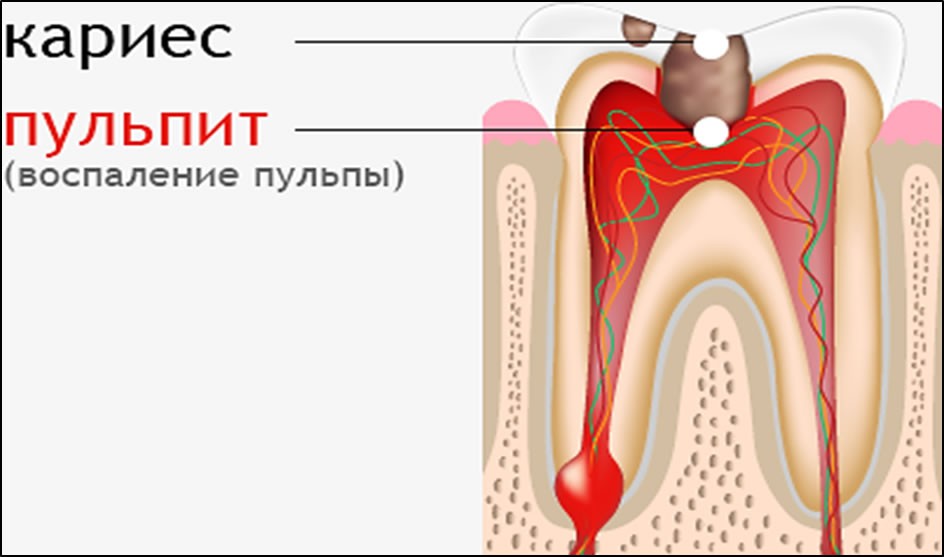 Как происходит удаление нерва из зуба в стоматологии: возможные последствия