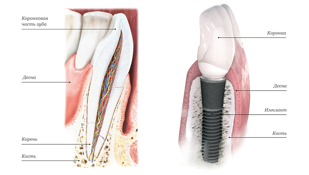 Причины и процедура удаление импланта зуба со штифтом. Опасные последствия