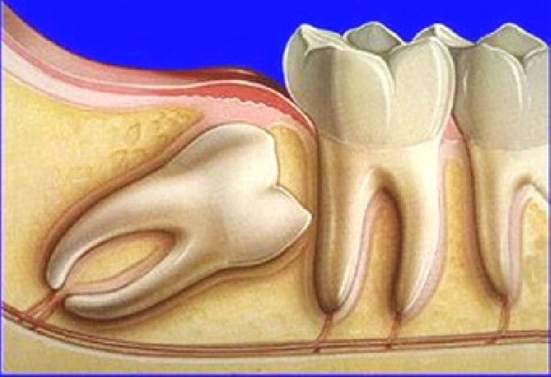 Зачем и какие зубы удаляют при установке брекетов: обязательно ли избавляться от зубов мудрости