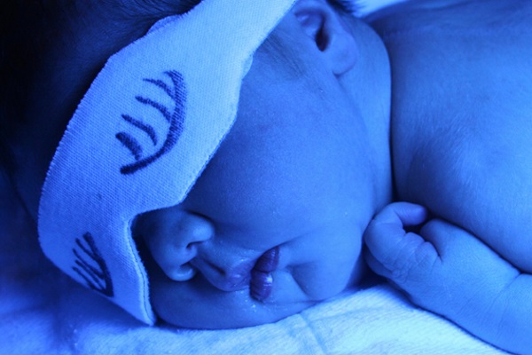 При проведении фототерапии новорожденному необходимо защищать глаза