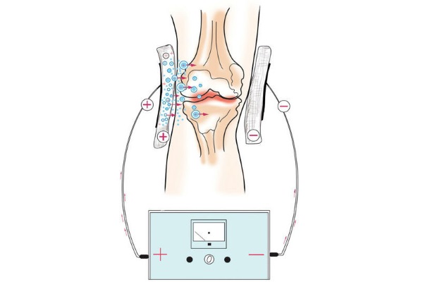 Расположение электродов при электрофорезе коленного сустава