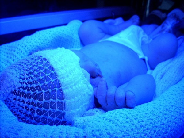 Фототерапия желтухи новорожденных