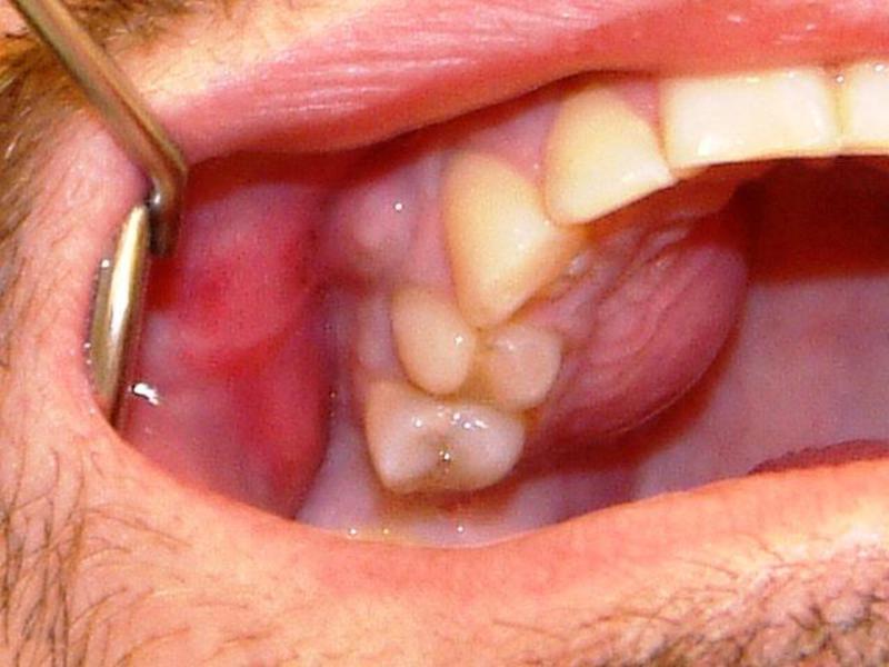 Киста слизистой оболочки в полости рта. Почему не стоит медлить с лечением