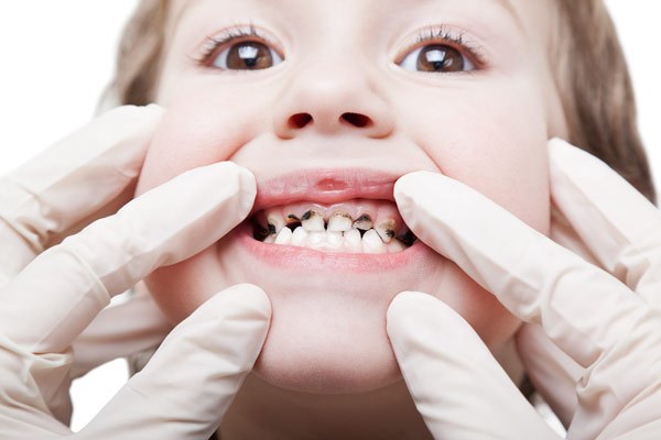 Разберемся, почему у детей чернеют молочные зубы кроется ли тут опасность?