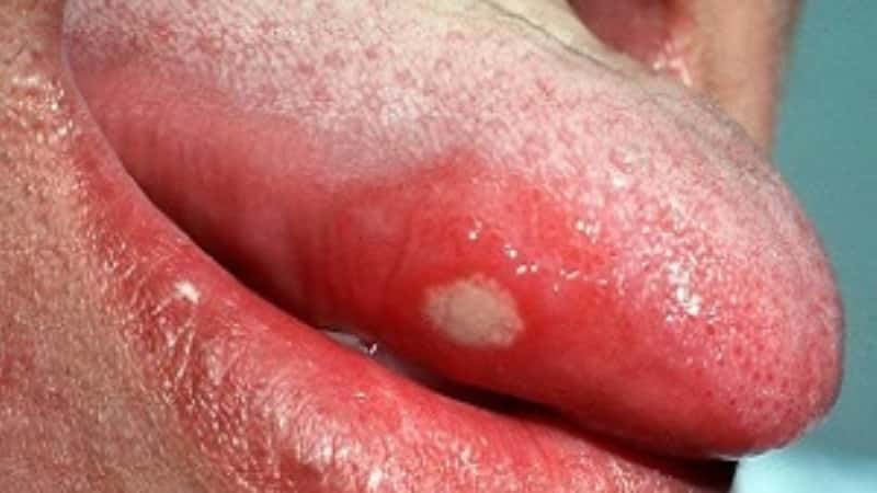 Поможет ли перекись водорода от запаха изо рта, стоматита, и зубной боли? Интересные факты