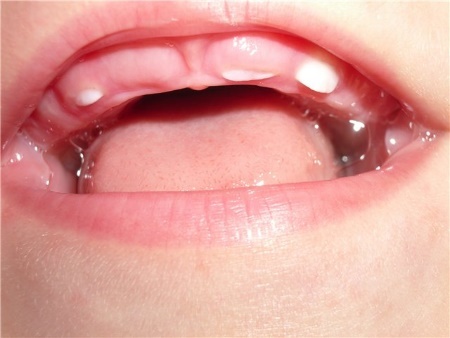 Знаки различия как отличить молочный зуб от коренного