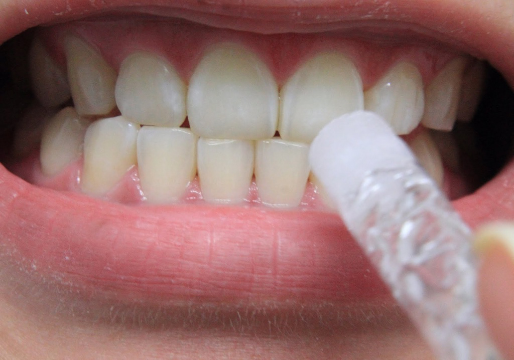 Выбираем лучший отбеливающий гель для зубов. Высокая эффективность не всегда безопасна