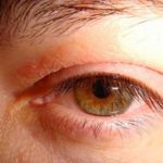Блефарит глаза и его лечение
