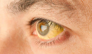 желтушность белков глаз при гепатите