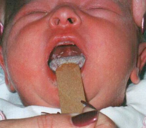 Чем лечить стоматит у детей во рту