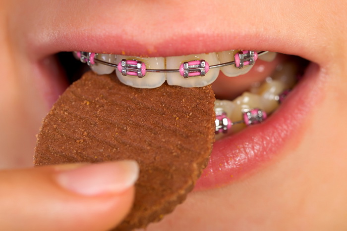 Исправляем прикус: как ставят брекеты на зубы, и какой врач это должен делать