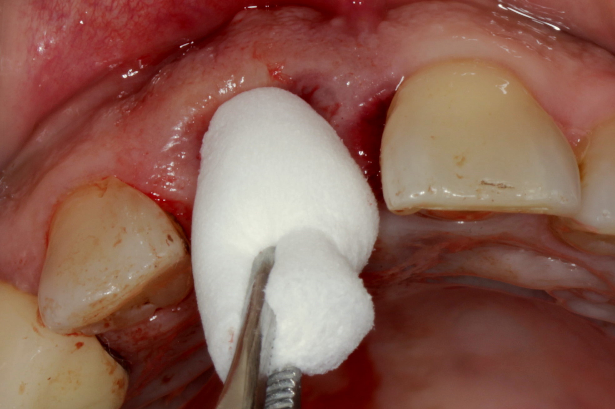 Торчит кость из десны после удаления зуба