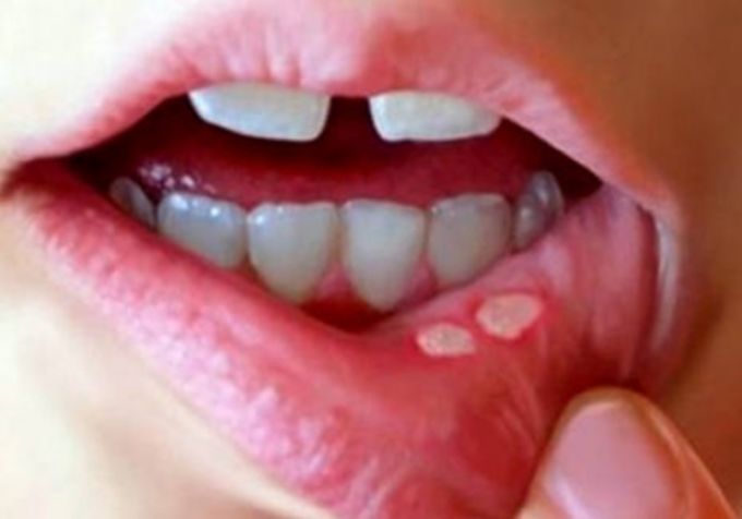 Чем лечить стоматит на губе у ребенка