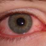 Почему глаза красные по утрам и как их лечить