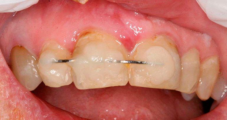 Зачем нужно шинирование зубов, и что это такое? Подвижные зубы больше не будут подвижными