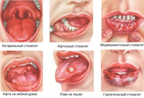 Куда обращаться с инфекцией во рту? Какой врач лечит стоматит у взрослых и детей