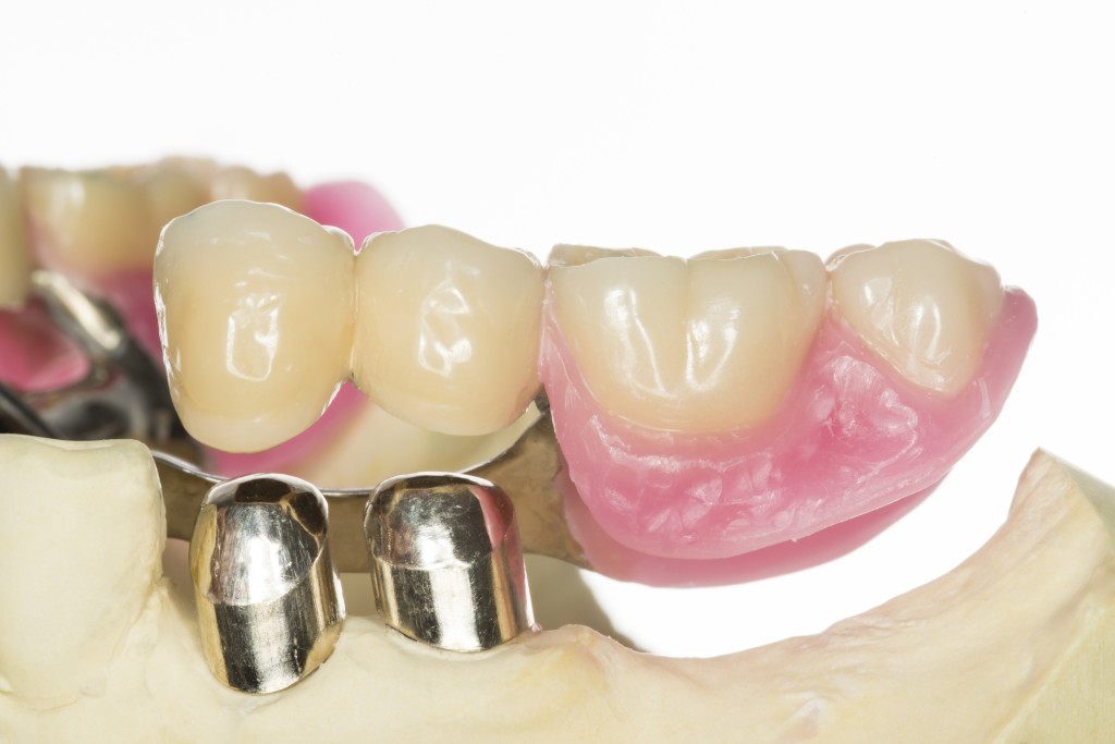 Что такое бюгельные зубные протезы и коронки. Описание, классификация, плюсы и минусы