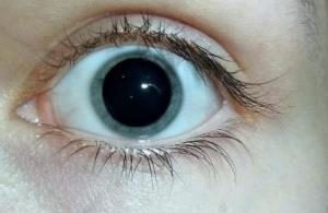 глаз человека с расширенным зрачком