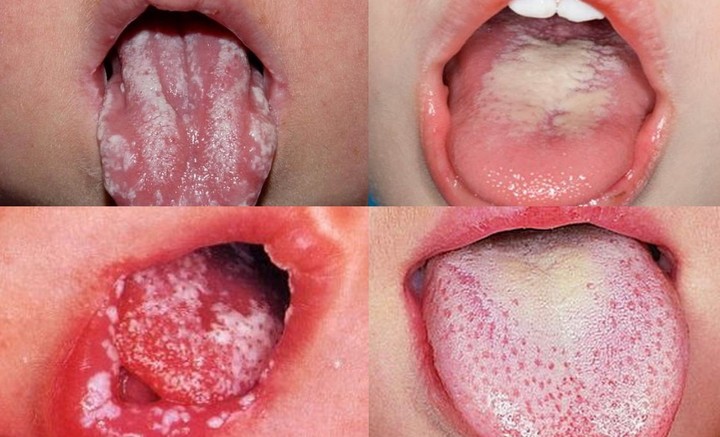 Симптомы и лечение кандидоза слизистой оболочки полости рта у взрослых. Какая у вас форма заболевания