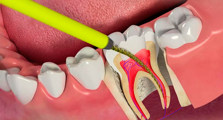 Может ли болеть зуб без нерва при нажатии? Что происходит под пломбой