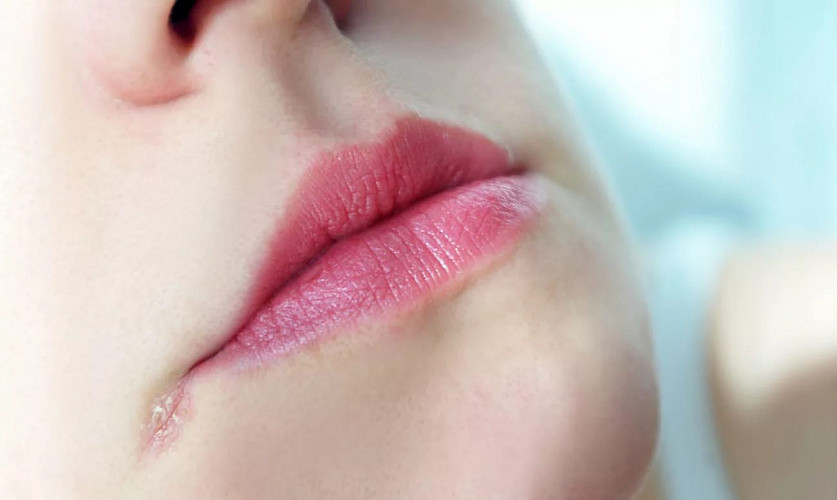 Причины и лечение ангулярного стоматита или ангулита. Как сделать уголки губ снова здоровыми и красивыми