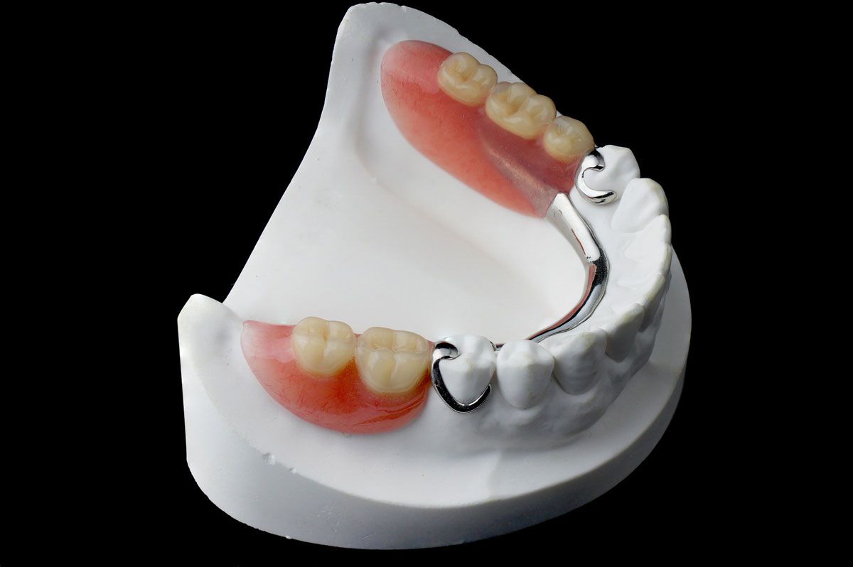 Какие протезы лучше при полном отсутствии зубов: съемные или несъемные. Особенности протезирования