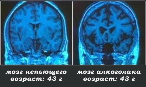 рентгеновские снимки мозга непьющего человека и алкоголика