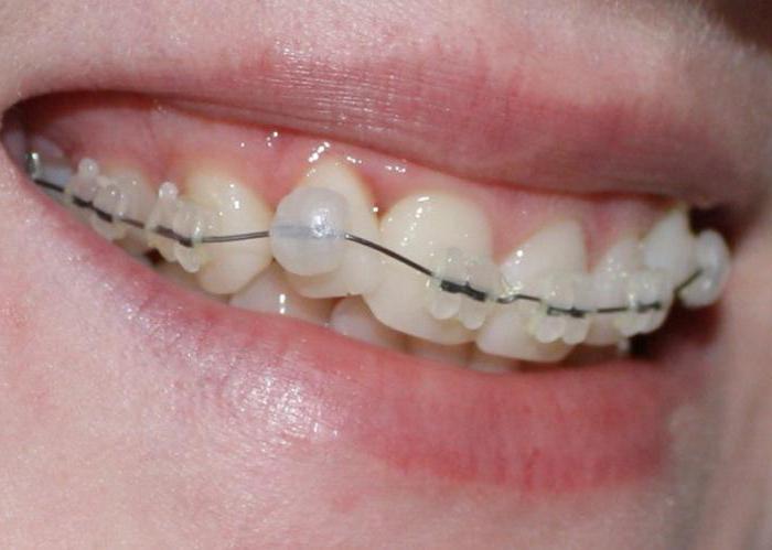 Это должен знать каждый, кто выравнивает зубы: что делать если брекет отклеился от зуба или натирает