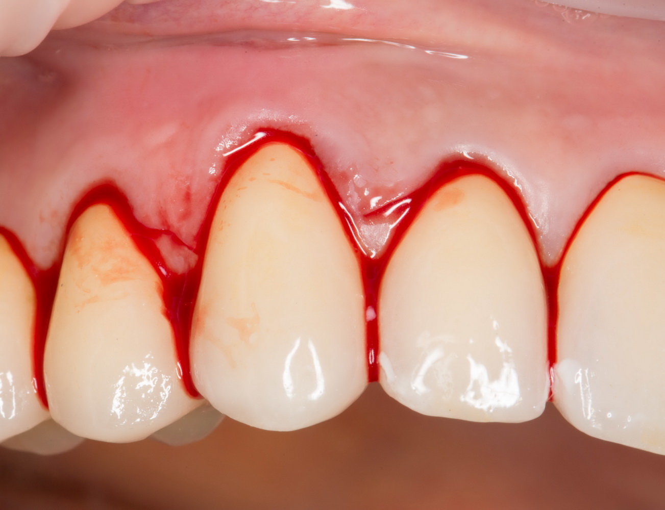 Красная зубная щетка? Симптомы и лечение острого гингивита у детей и взрослых.