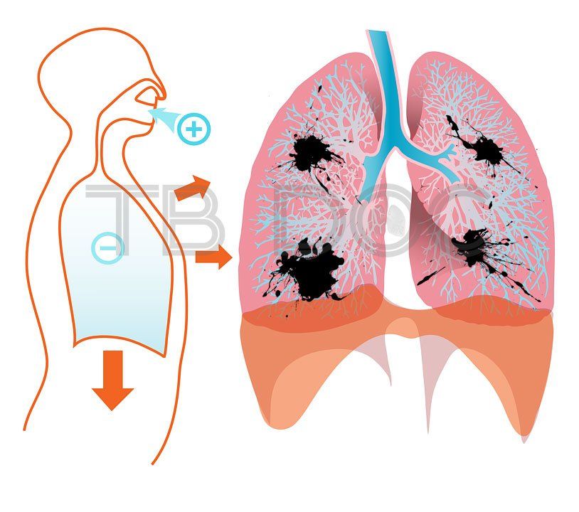 Диссеминированный туберкулез легких: схема