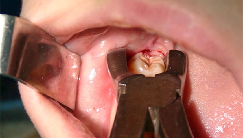 Опасные последствия удаления коренного зуба