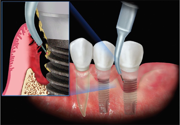Какие противопоказания и возможные осложнения могут быть у имплантации зубов. Почему отторгаются импланты