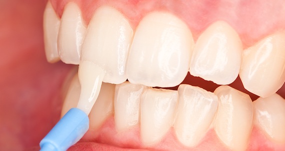 Глубокое фторирование зубов у детей не опасно ли?