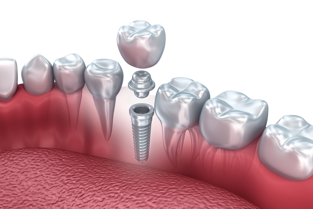 Что такое имплантация зубов и как она делается. Обзор методов вживления зубов