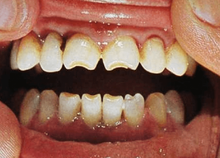 Чем опасна гипоплазия эмали зубов у детей лечение и причины