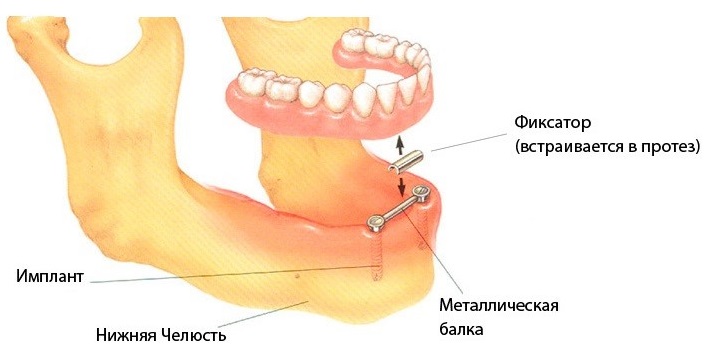Какие протезы лучше при полном отсутствии зубов: съемные или несъемные. Особенности протезирования