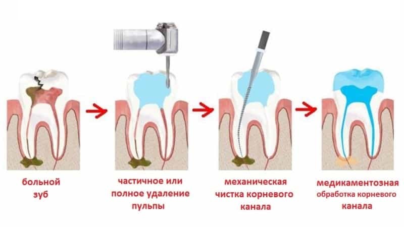 Лечение и чистка каналов зуба: а не больно ли это? Почему зверь не так страшен