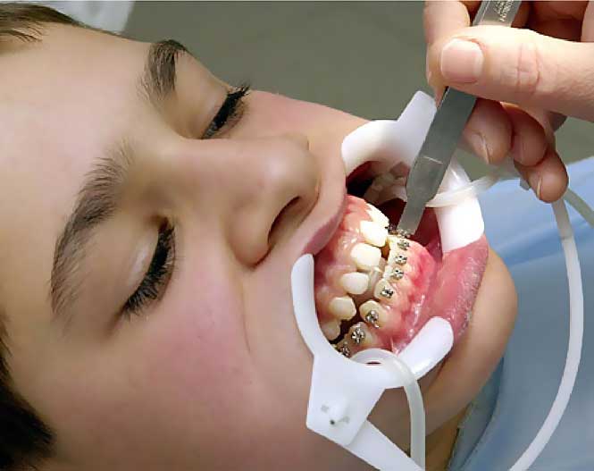 Исправляем прикус: как ставят брекеты на зубы, и какой врач это должен делать