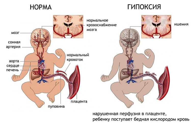 Схема проявления гипоксии плода