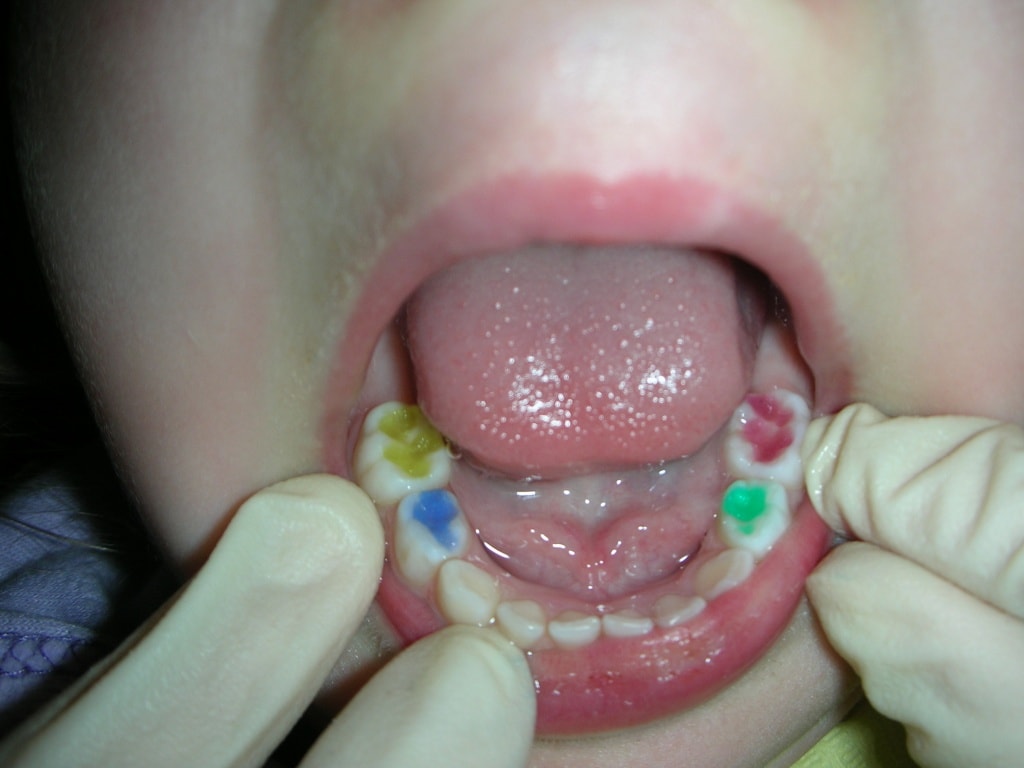 Возможно ли лечение кариеса молочных зубов без бормашины
