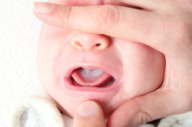 Появилась молочница на языке у ребенка как избавиться