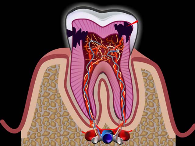 Что такое пульпит молочного зуба первые признаки и правильное лечение