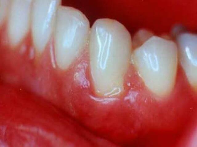 Что делать, если воспалилась десна около зуба. Причины и лечение у стоматолога и в домашних условиях