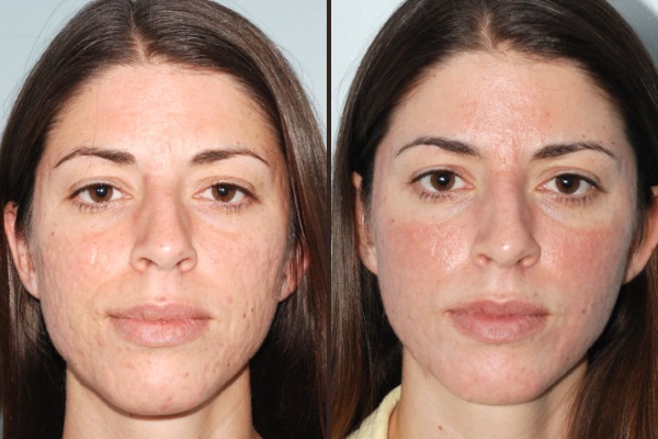 До и после фракционного омоложения кожи лица