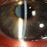 Грибковые заболевания глаз
