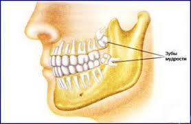Зачем и какие зубы удаляют при установке брекетов: обязательно ли избавляться от зубов мудрости