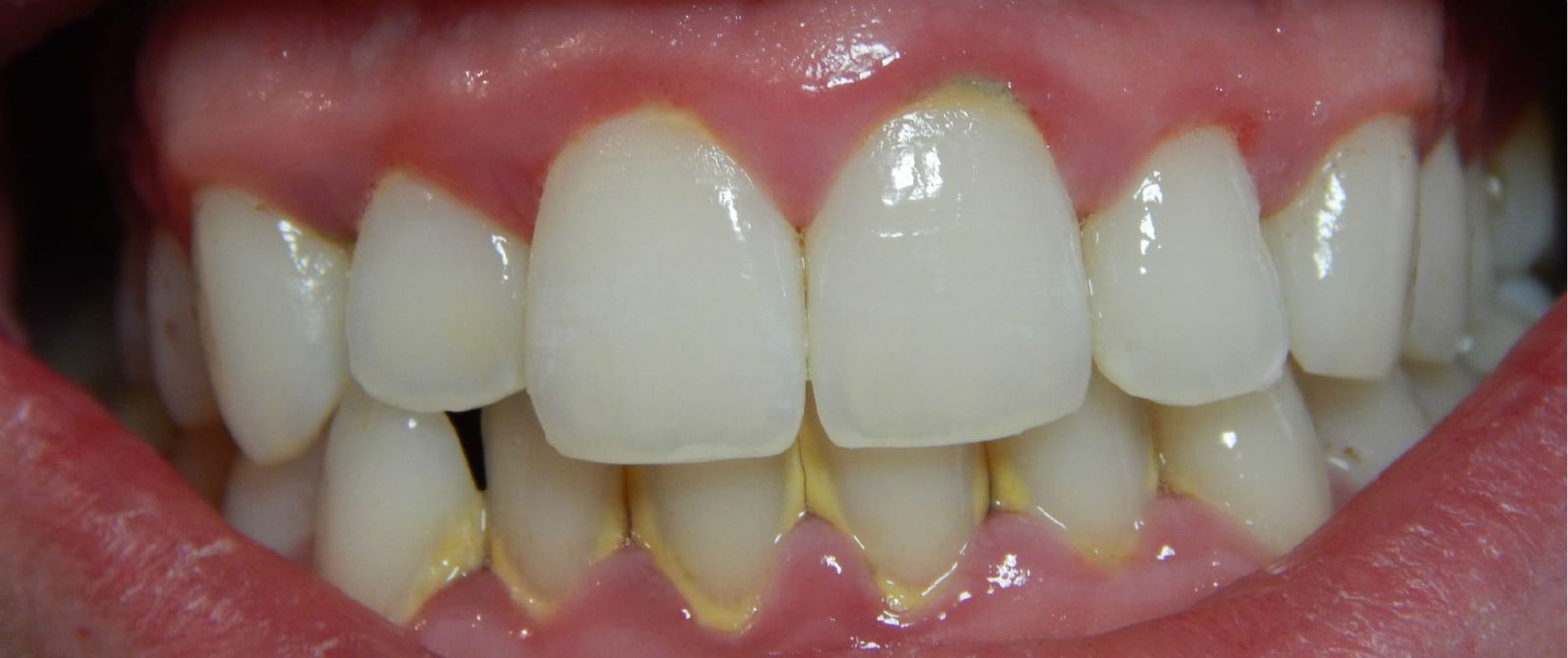 Глубокая чистка зубов или удаление зубного камня. В чем опасность твердых отложений на зубах