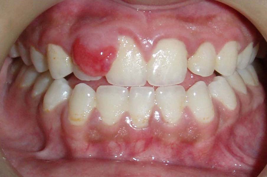 Методы лечения кисты зуба без удаления. Что будет, если не лечить